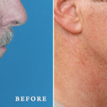 Picerno_Denver-Lone-Tree_Chin-Augmentation-3-RightLAT