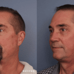 Picerno_Denver-Lone-Tree_Lower-Facelift-Necklift-1-LeftOBL (1)