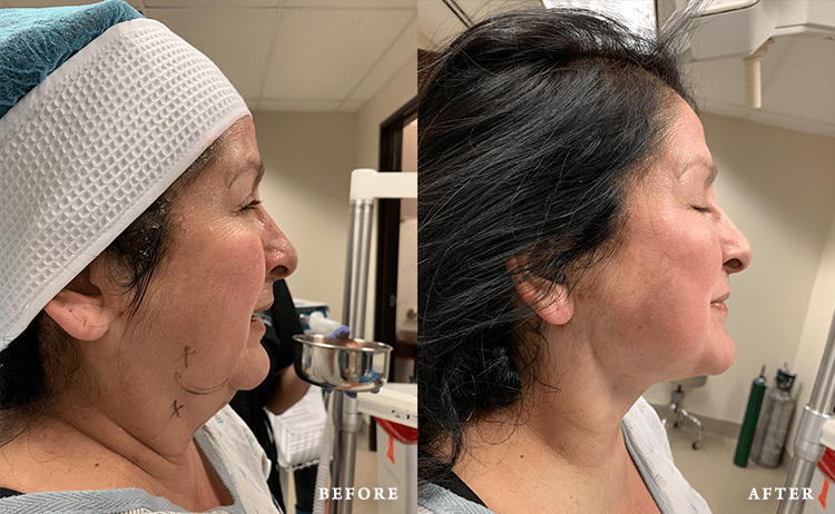 before_after_img