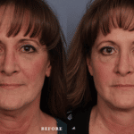 Picerno_Denver-Lone-Tree_Lower-Facial-Rejuvenation-2-AP