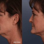 Picerno_Denver-Lone-Tree_Lower-Facial-Rejuvenation-2-Right
