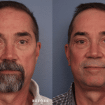 Picerno_Denver-Lone-Tree_Lower-Facial-Rejuvenation-Jesner-Peel-3-AP