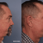 Picerno_Denver-Lone-Tree_Lower-Facial-Rejuvenation-Jesner-Peel-3-Right