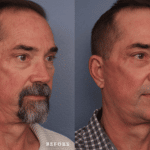 Picerno_Denver-Lone-Tree_Lower-Facial-Rejuvenation-Jesner-Peel-3-RightOBL