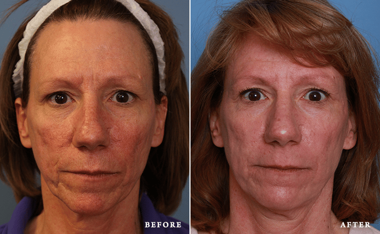 before_after_img