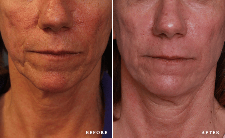 before_after_img