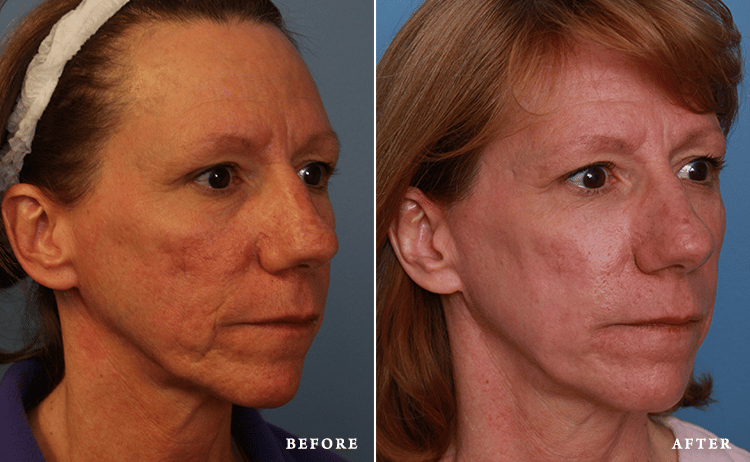before_after_img