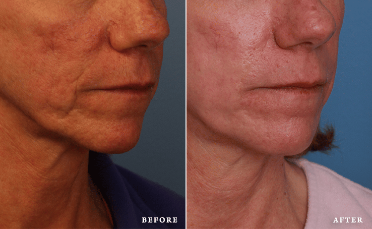 before_after_img