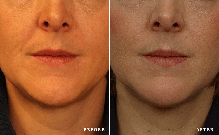 before_after_img