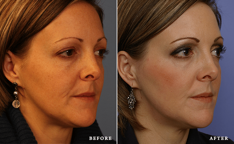 before_after_img