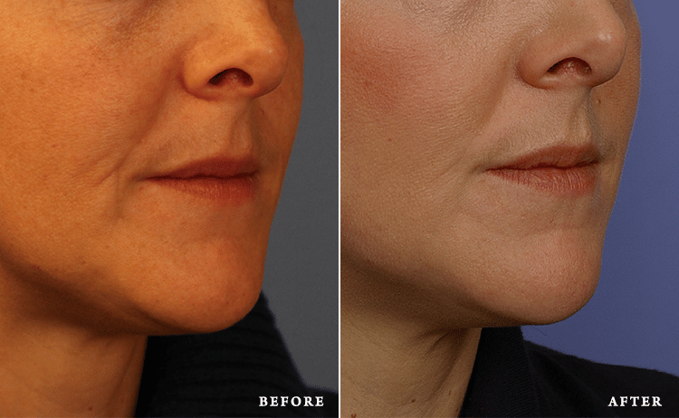 before_after_img