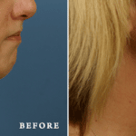 Picerno_Denver-Lone-Tree_Submental-Liposuction-1-RightLAT