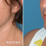 Picerno_Denver-Lone-Tree_Submental-Liposuction-2-LeftOBL