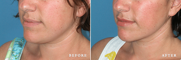 before_after_img