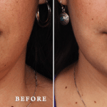 Picerno_Denver-Lone-Tree_Submental-Liposuction-3-AP