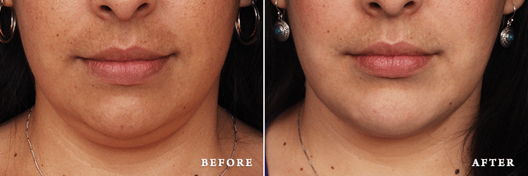 before_after_img