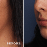 Picerno_Denver-Lone-Tree_Submental-Liposuction-3-LeftOBL