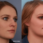 Picerno_Denver-Lone-Tree_Rhinoplasty-45-RightOBL
