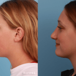 Picerno_Denver-Lone-Tree_Rhinoplasty-46-Left