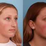 Picerno_Denver-Lone-Tree_Rhinoplasty-46-RightOBL