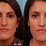 Picerno_Denver-Lone-Tree_Lower-Rhinoplasty-47-AP