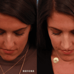 Picerno_Denver-Lone-Tree_Lower-Rhinoplasty-47-Above