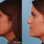 Picerno_Denver-Lone-Tree_Lower-Rhinoplasty-47-Left