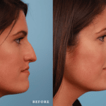 Picerno_Denver-Lone-Tree_Lower-Rhinoplasty-47-Right