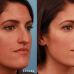 Picerno_Denver-Lone-Tree_Lower-Rhinoplasty-47-RightOBL