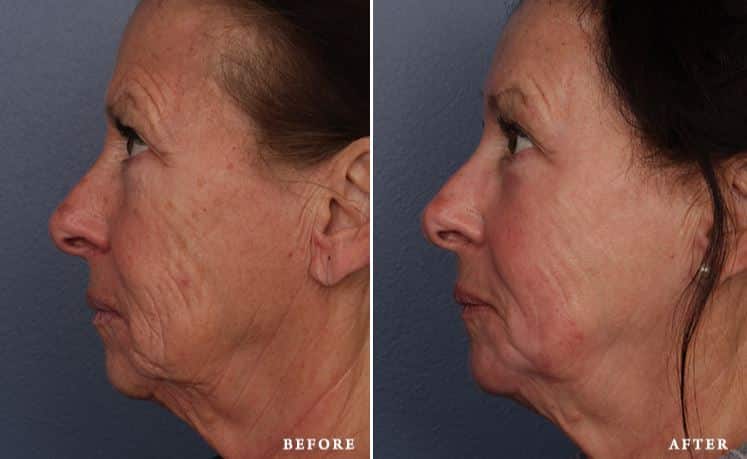 before_after_img