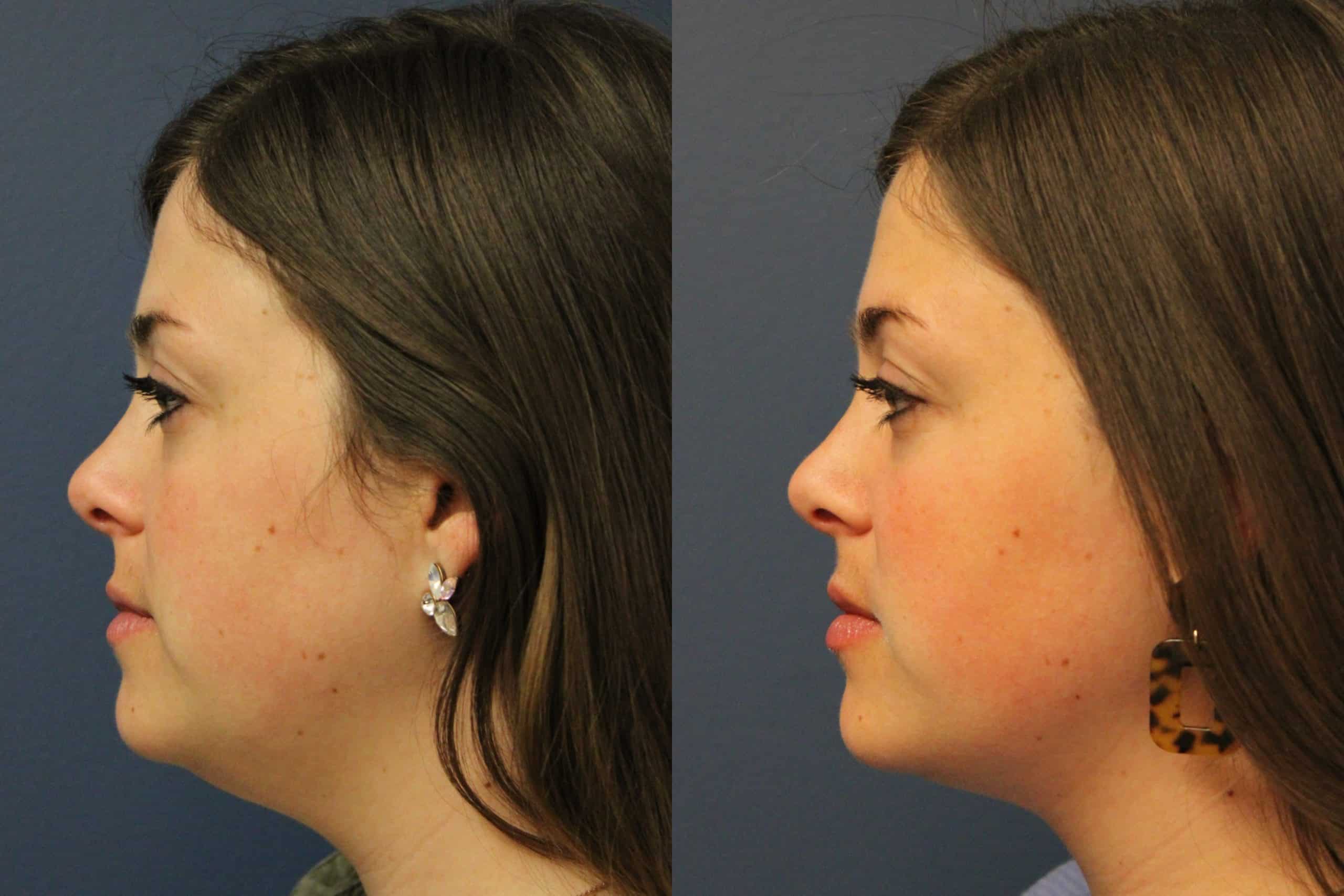 before_after_img