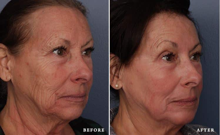 before_after_img