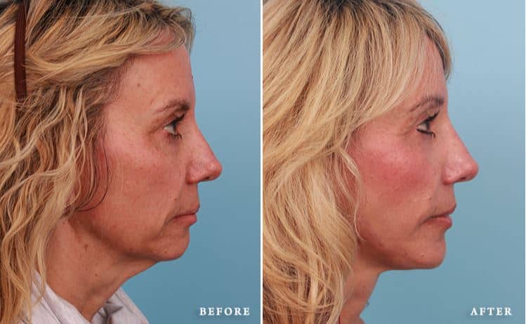 before_after_img
