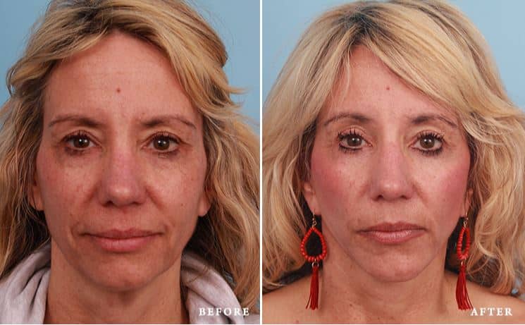 before_after_img