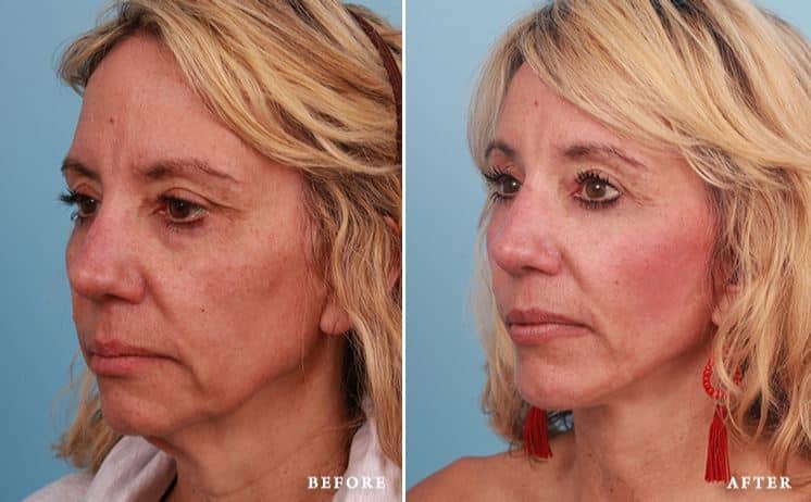 before_after_img