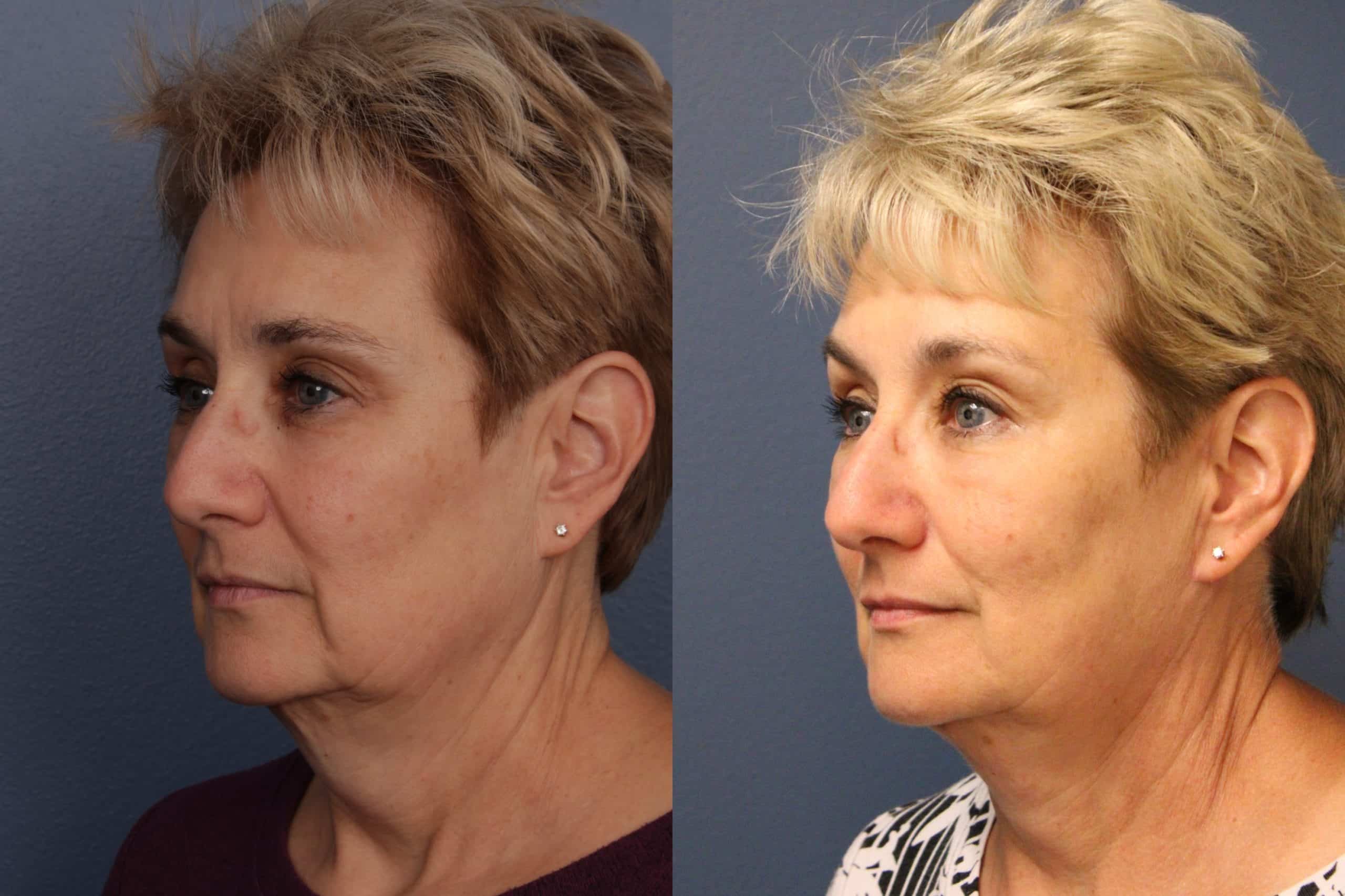 before_after_img