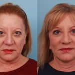 Facelift and Upper Bleph1