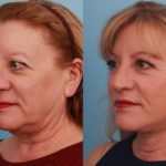 Facelift and Upper Bleph2