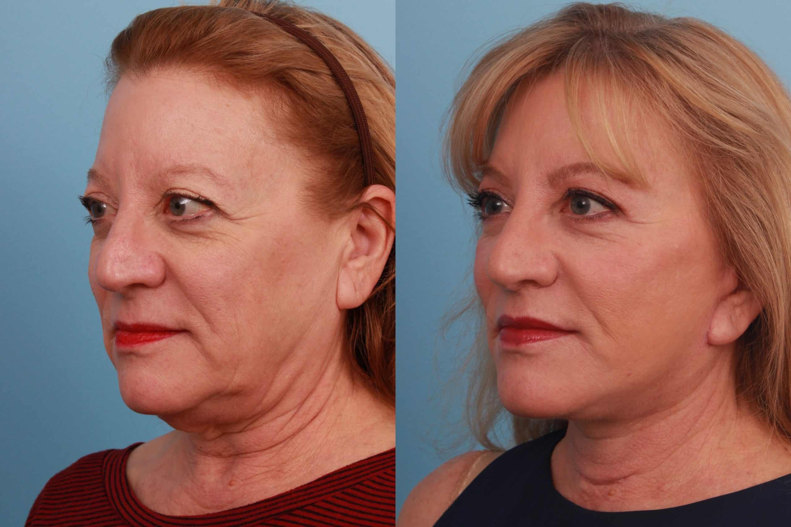 before_after_img