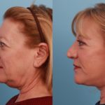 Facelift and Upper Bleph3