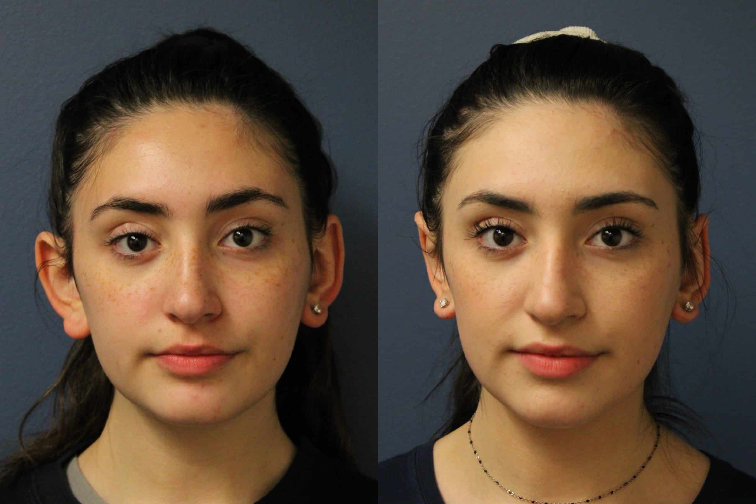 before_after_img