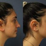 Otoplasty2 (2)