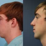 Rhinoplasty 4