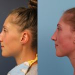 Rhinoplasty 6 Weeks post-op (1)