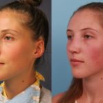 Rhinoplasty 6 Weeks post-op (2)