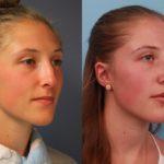 Rhinoplasty 6 week post-op