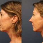 Facelift 2