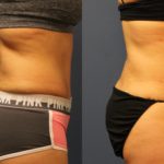 Flanks lipo