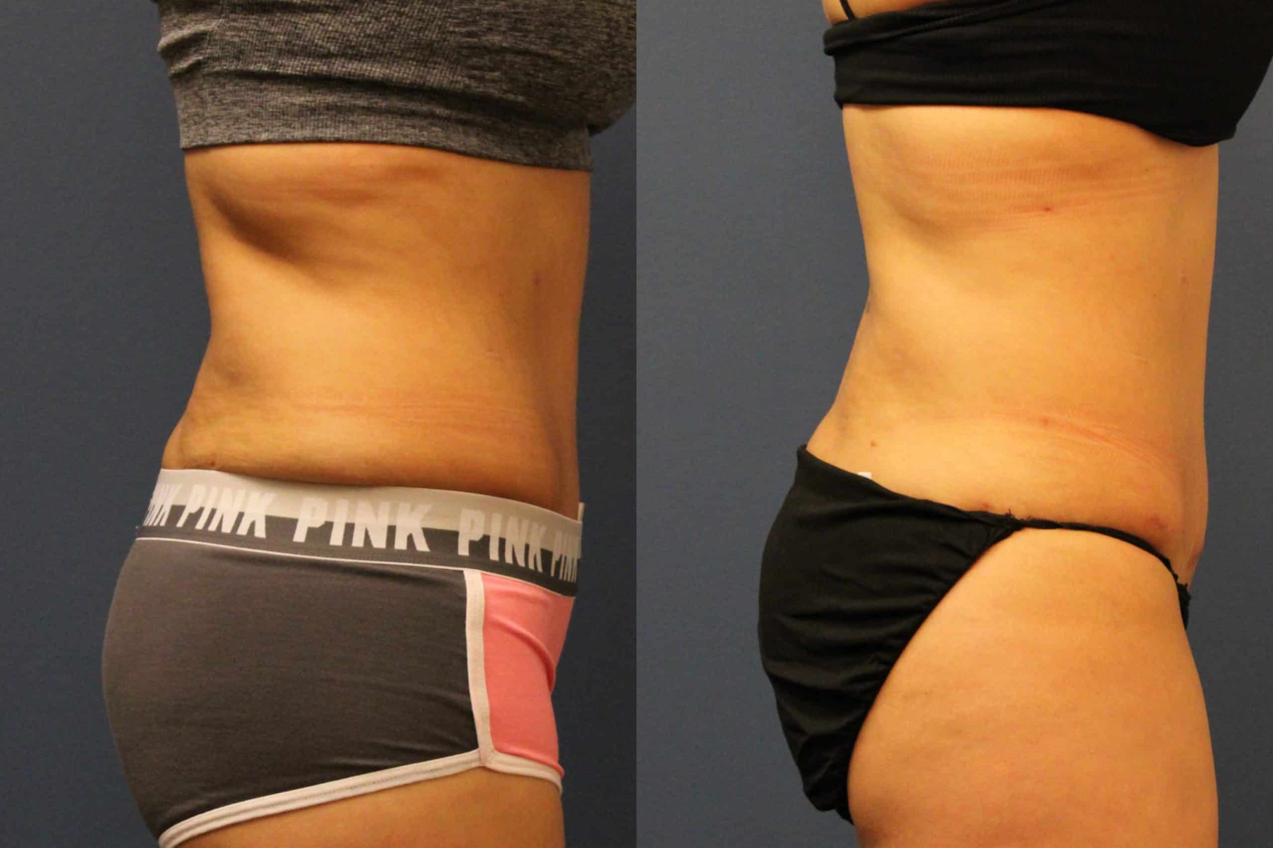 before_after_img