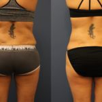 Flanks lipo1